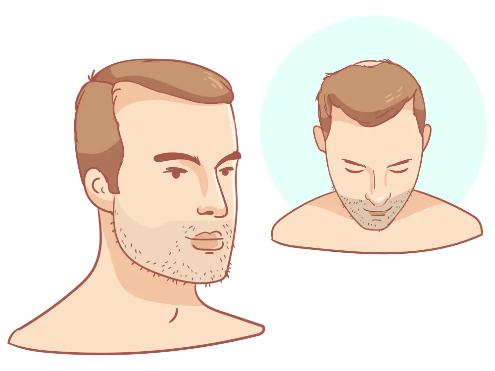 Receding hairline + light crown