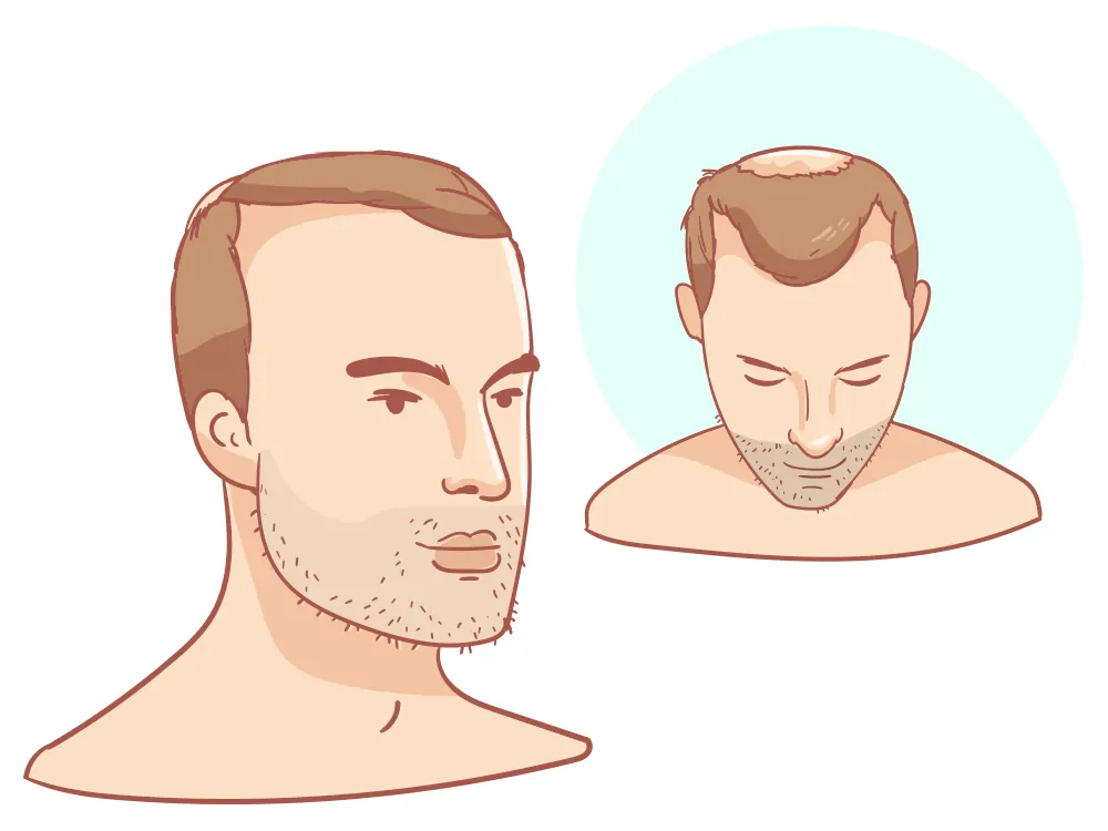 Receding hairline Strong + Crown
