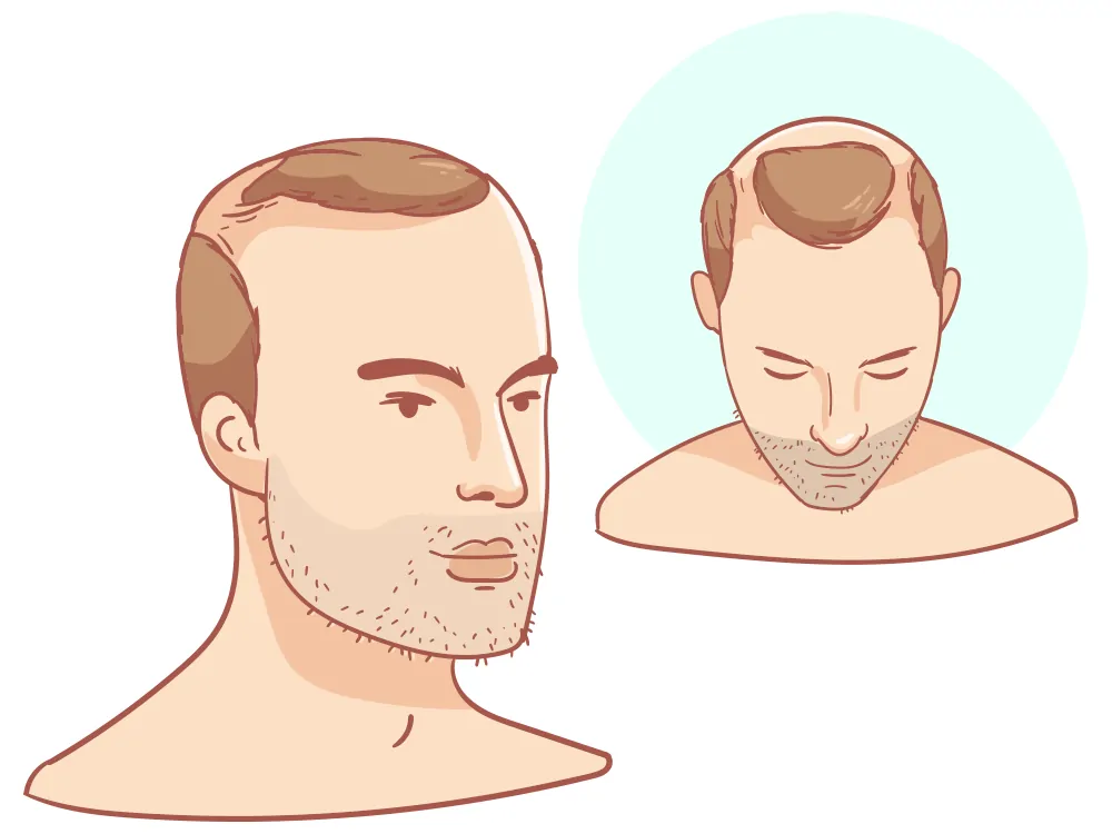 Half bald